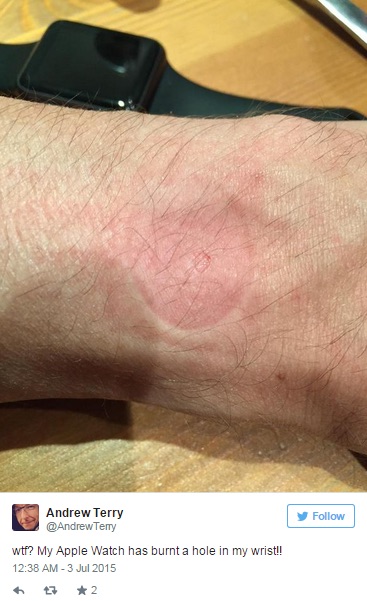 Primi casi di allergia da Apple Watch